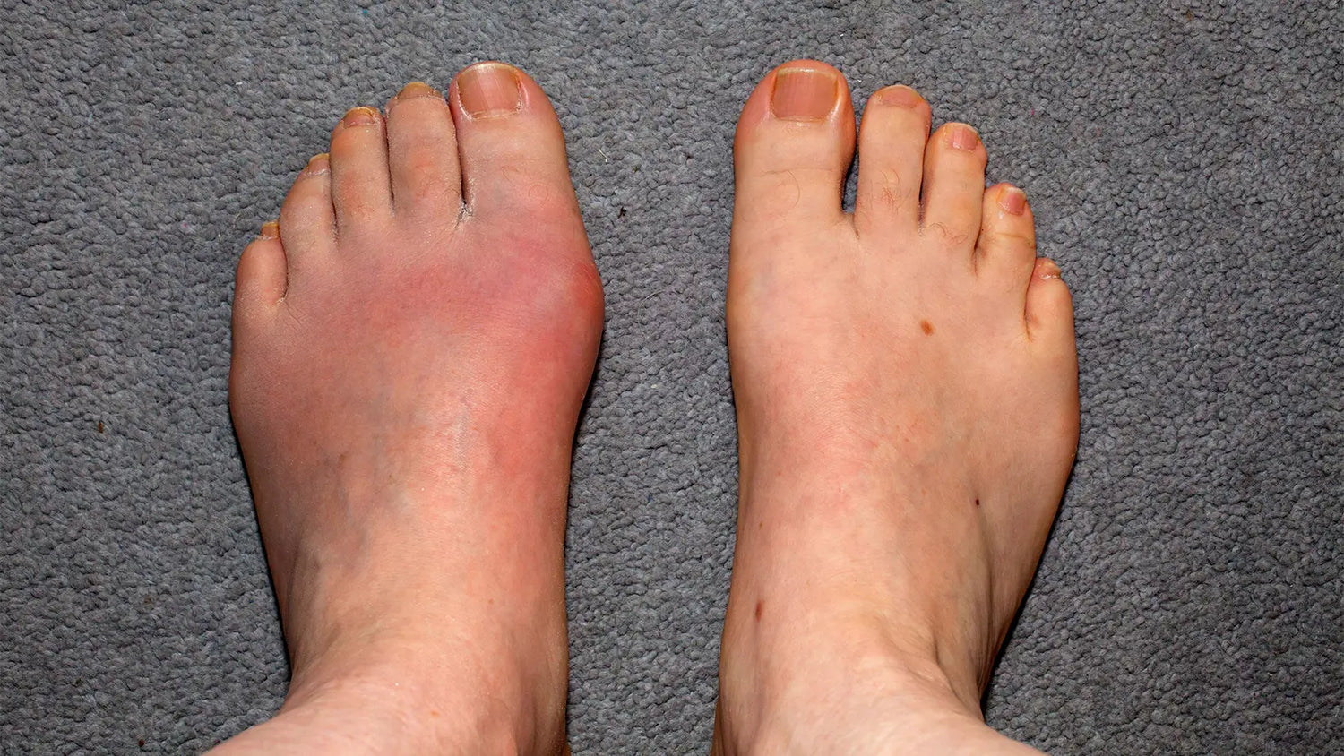 Gout and Your Diet: Separating Fact from Fiction